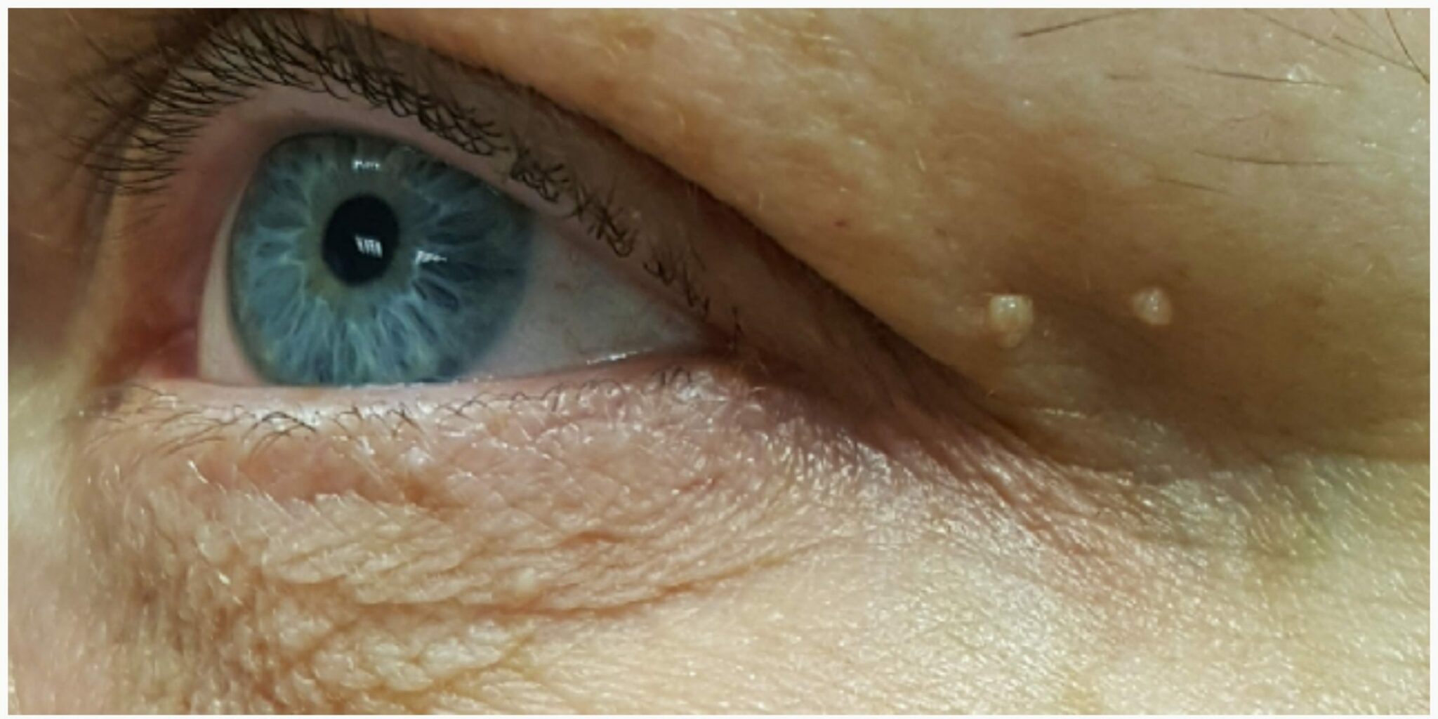 Fibrome Arzte und Laserzentrum in Frankfurt und Wiesbaden