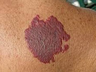 Laserbehandlung Feuermale Arzte und Laserzentrum Frankfurt Wiesbaden