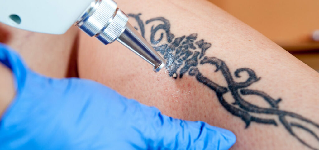 PicoWay Laser Tattoo Entfernung Frankfurt und Wiesbaden