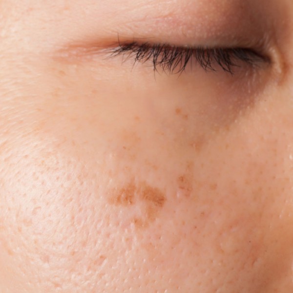 Pigmentation Alters Pigmentflecken im Arzte und Laserzentrum Frankfurt Wiesbaden