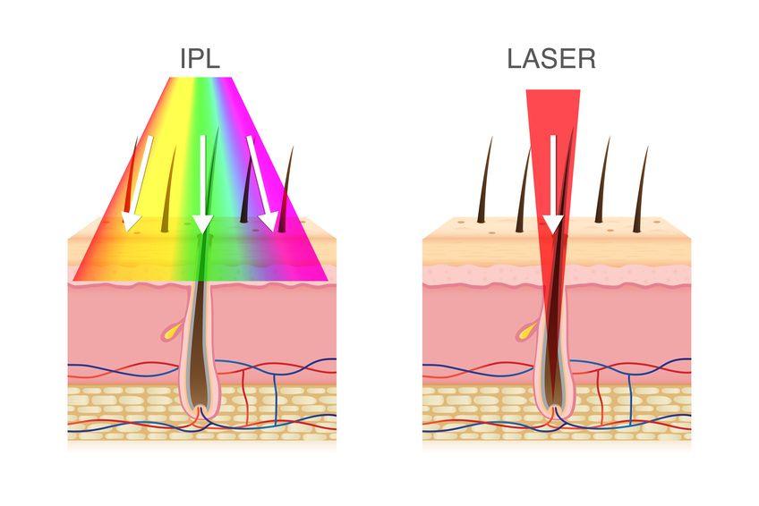 Laser Haarentfernung und IPL Frankfurt Wiesbaden
